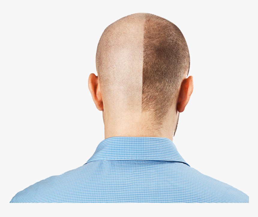 111-1117131_hair-transplant-stock-hd-png-download